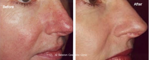 laser for spider veins on face laser for spider veins on face