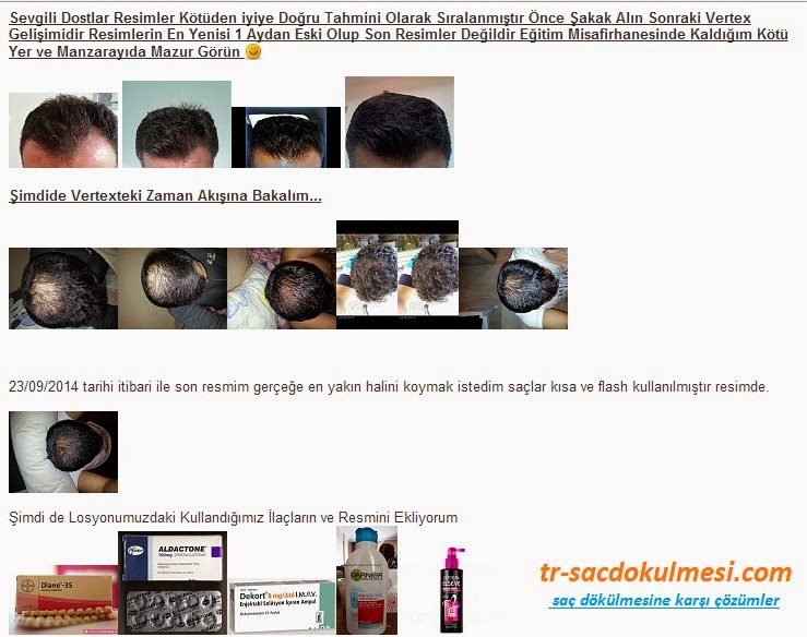 saç dökülmesi saç dökülmesi