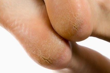 Home-Remedies-For-Cracked-Heels