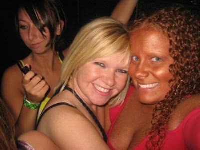 ضحايا حروق الشمس 