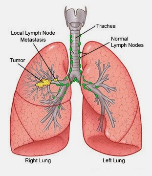 ICD 9 Code For Lung Cancer