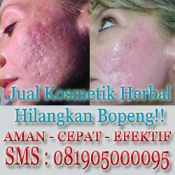 Produk Kecantikan Hilangkan Bopeng Jerawat