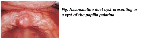 Nasopalatine duct cyst (incisive canal cyst) 1 Nasopalatine duct cyst (incisive canal cyst)