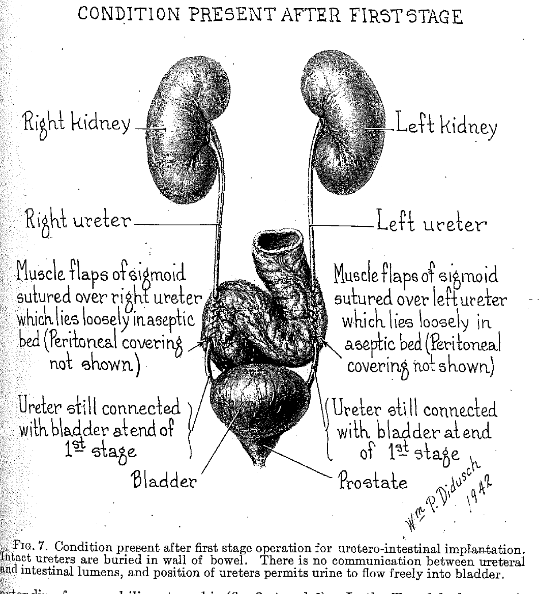Brady Urology at Johns Hopkins Hospital Historical Contribution 1942