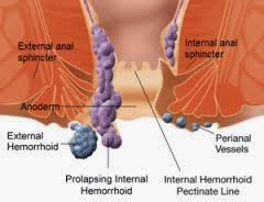 wasir obat herbal wasir
