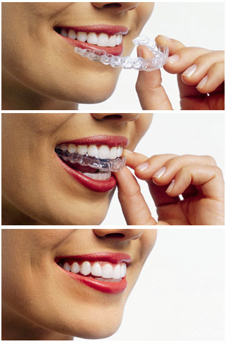 invisalign invisalign clear braces