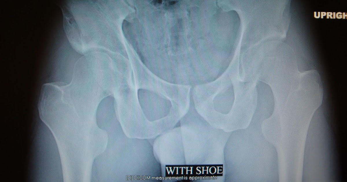 Foot and Ankle Problems By Dr. Richard Blake Functional Short Leg