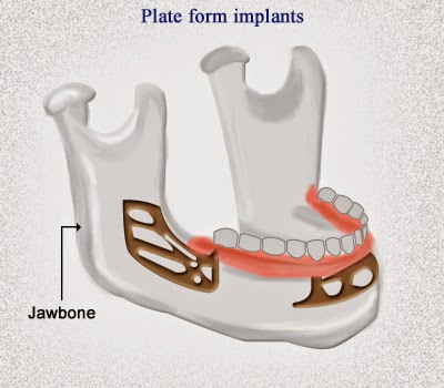 types d'implants dentaires 2