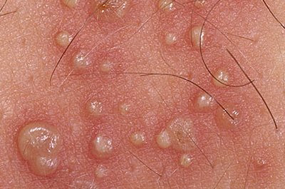 Polni Herpes
