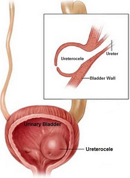 radiography in ureterocele Plain radiography of the kidney, ureter, and bladder demonstrated ureteral stones in the right distal location (figure 1) cobra-head stone in single-system ureterocele. radiography in ureterocele Plain radiography of the kidney, ureter, and bladder demonstrated ureteral stones in the right distal location (figure 1) cobra-head stone in single-system ureterocele.