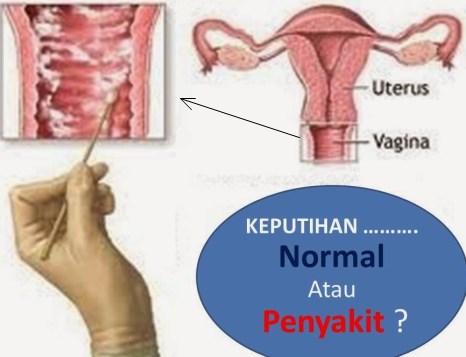 Cara Mengatasi Keputihan Cara alami Mengatasi Keputihan