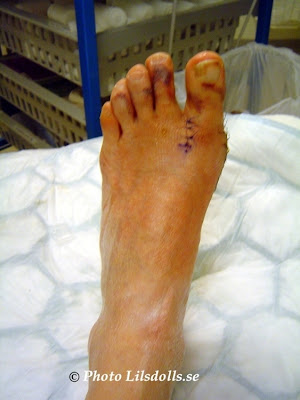 hallux valgus, halluxvalgus-operation, byte av gips