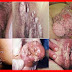 Perontok Kutil yang Tumbuh di Anus thumbnail