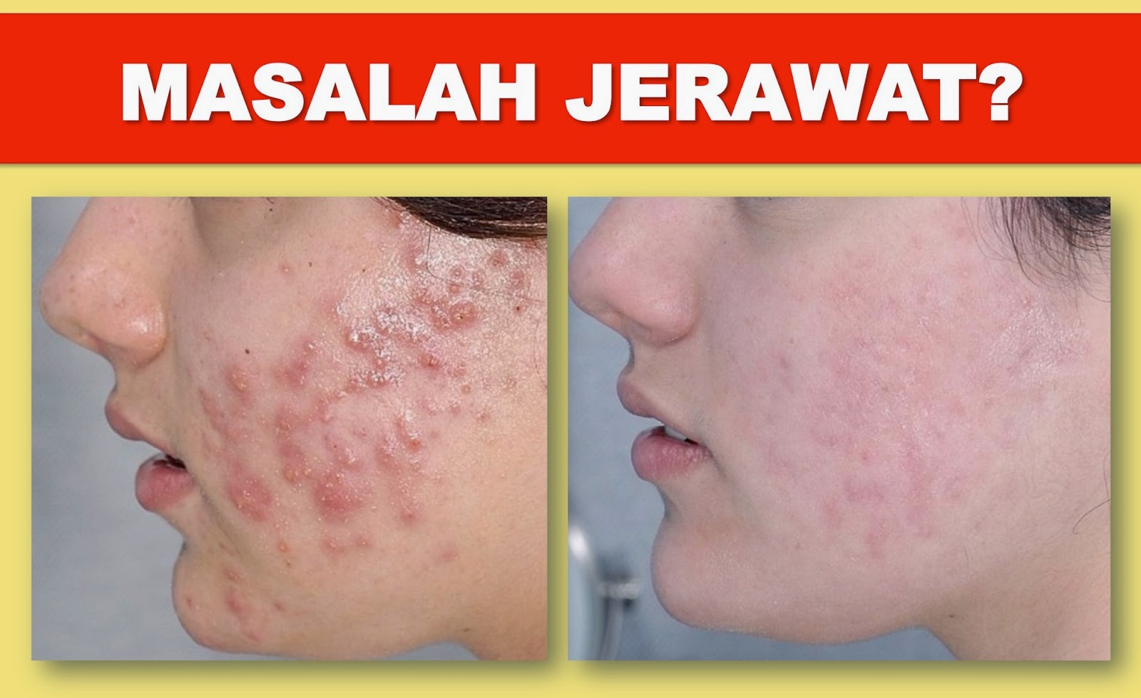 Masalah Jerawat Cubalah SET KECANTIKAN KULIT SHAKLEE untuk kulit bebas jerawat