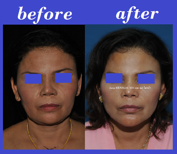 1 Plastic Surgery In Thailand Facelift Surgery Photos