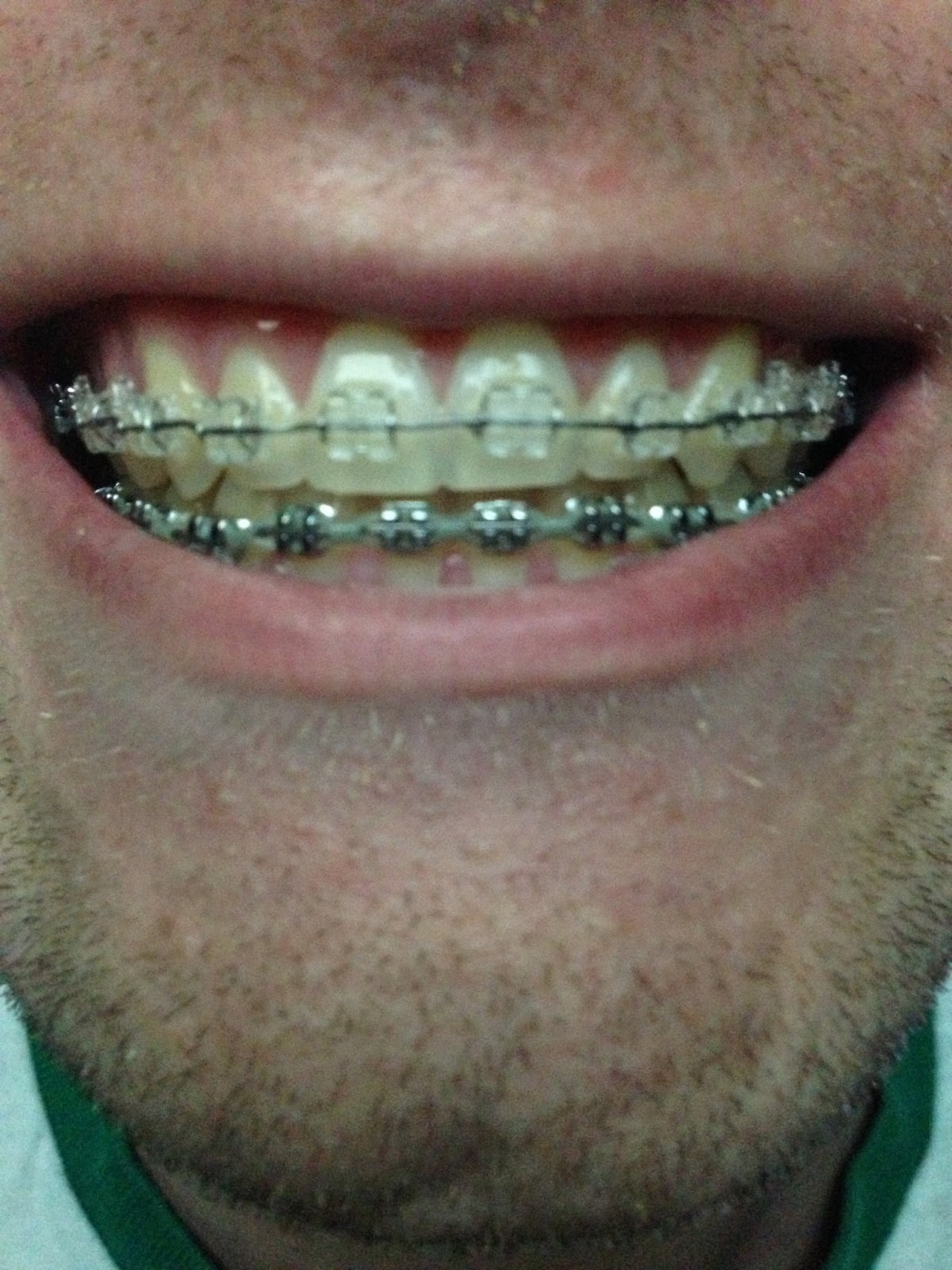 Braces/Open Bite Surgery Orthodontist Appointment (New Pics)