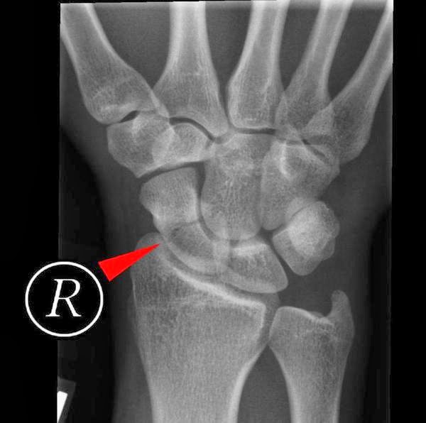 HAND AND WRIST SURGERY Dr Narender Saini Scaphoid bone fracture in
