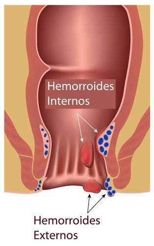 Hemorroides: Minuto Medico