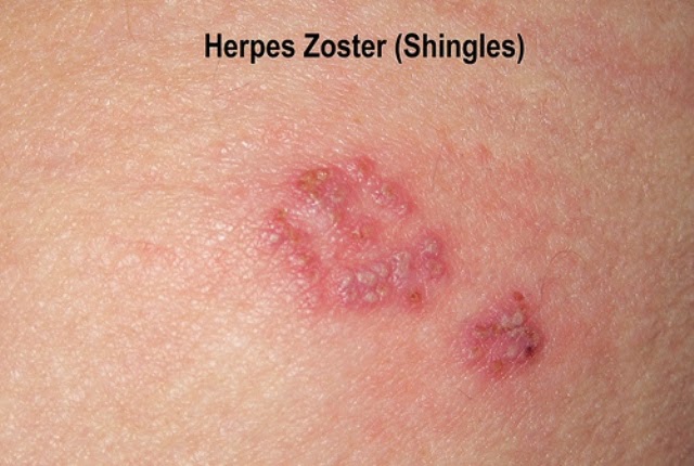 Herpes VS Genital Warts Difference