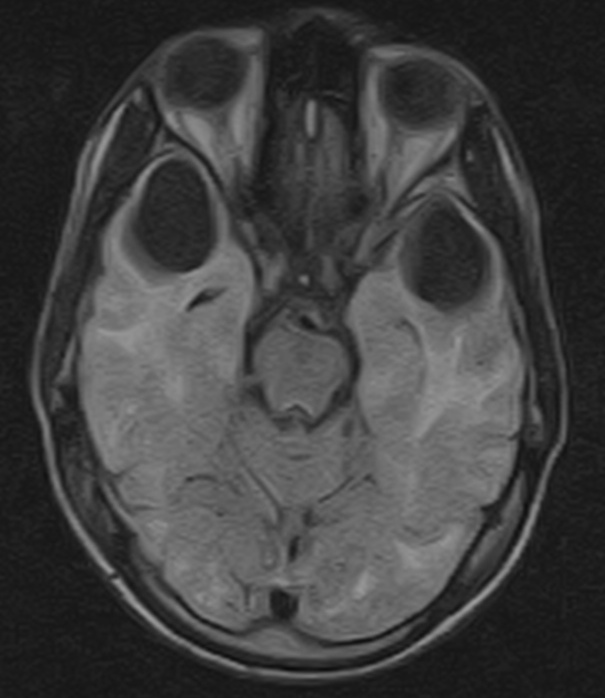 Van der knaap disease, a megalencephalic leukoencephalopathy Sumer's