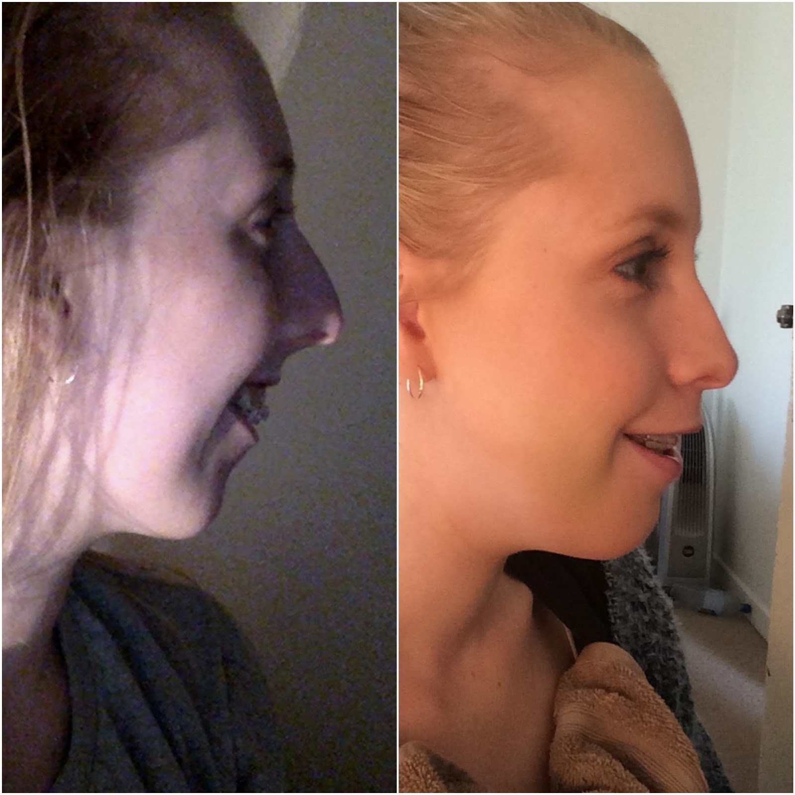 Double Jaw Surgery Journey 3 weeks post