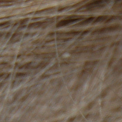 Head Lice Nits Picture