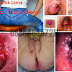 Wasir,Anus Meradang dan Membengkak thumbnail