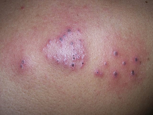 Can you get genital herpes from oral sex images 724