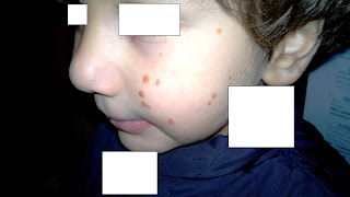 Allergic Rash On Face Toddler : Urticaria In Children