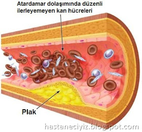 damar sertliği, damar tıkanıklığı