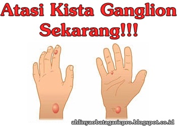 Obat Kista Ganglion Obat Kista Ganglion