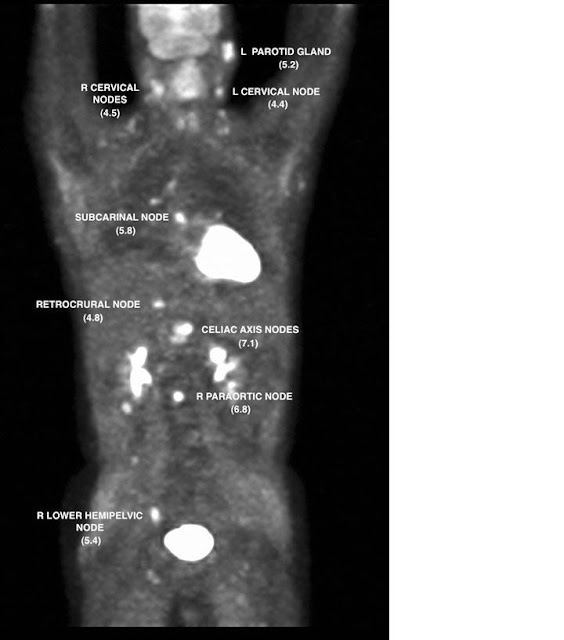 SCIENTIFIC MANIA NonHodgkin's lymphoma case studies with DCA