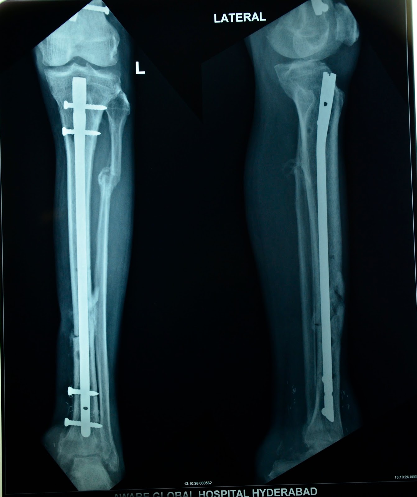 CRUSH INJURY FOOT WITH OPEN ANKLE JOINT FREE FLAP FAILURE SALVAGE