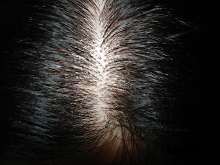 Hair Loss In Young Men
