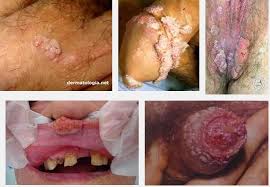 Obat Oral Condyloma Obat Oral Condyloma