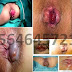 Obat Salep Benjolan Wasir di Apotik thumbnail