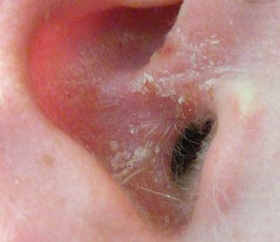 Discussion on this topic: About Cancer of The ear Canal Middle , about-cancer-of-the-ear-canal-middle/ Forum on this topic: About Cancer of The ear Canal Middle , about-cancer-of-the-ear-canal-middle/