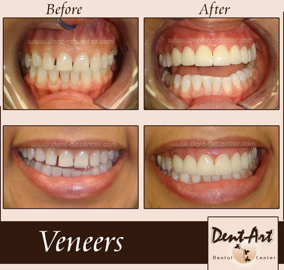 Dental Implants Dent Art Center