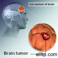Brain Cancer Brain Cancer