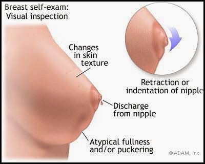 Image Obat Anti Kanker Payudara