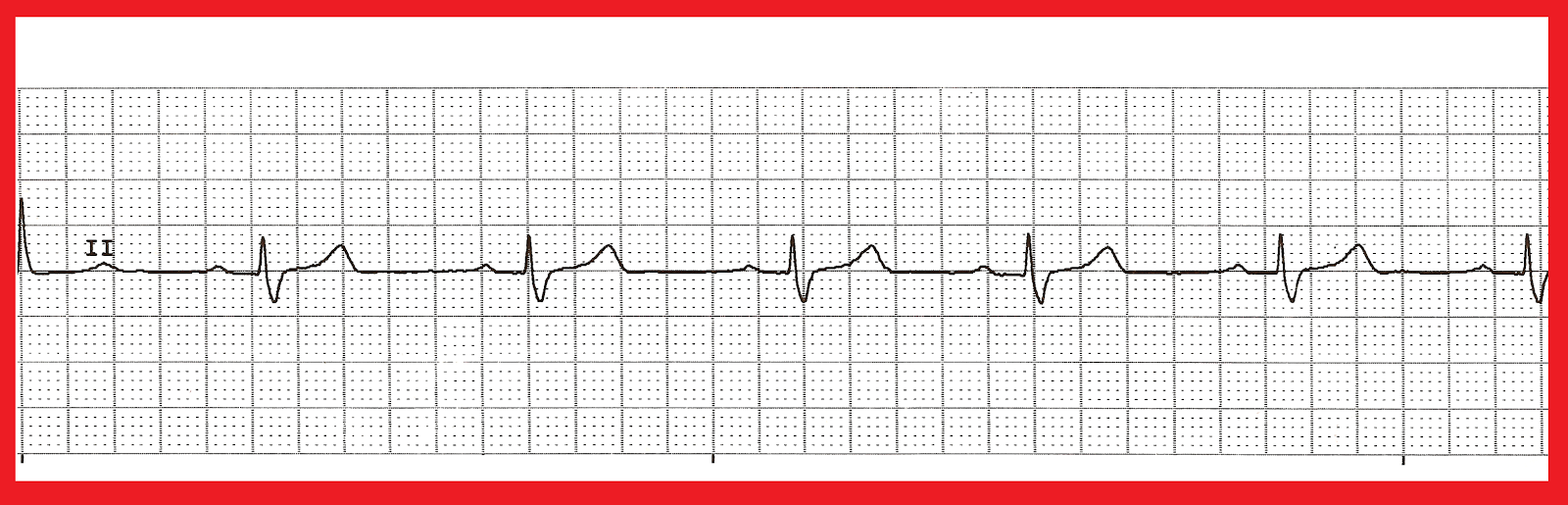 Bradycardia