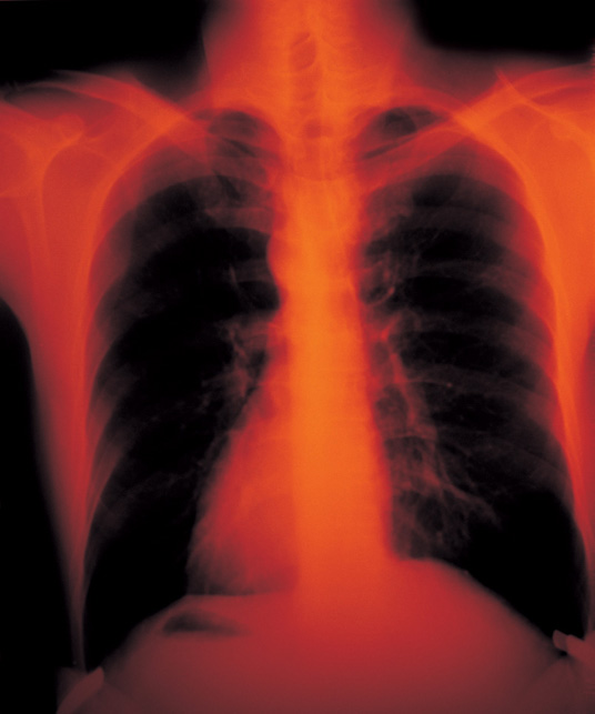 Infection - PHILIPPINE NURSE