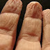 Why do our fingers wrinkle in water?