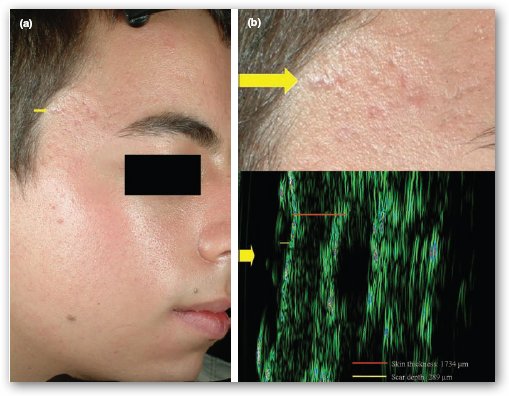 Acne Destroyer: Cystic...