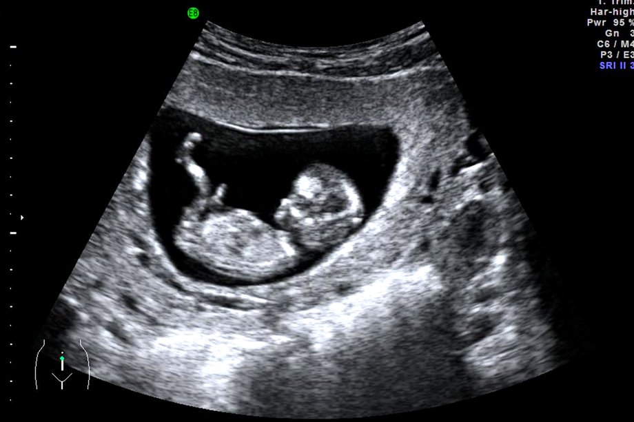 Fetal Ultrasound Dubai