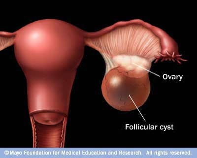 Cyst premium beautiful corset membantu mencegah kanser payudara, rahim dan otak dan cyst