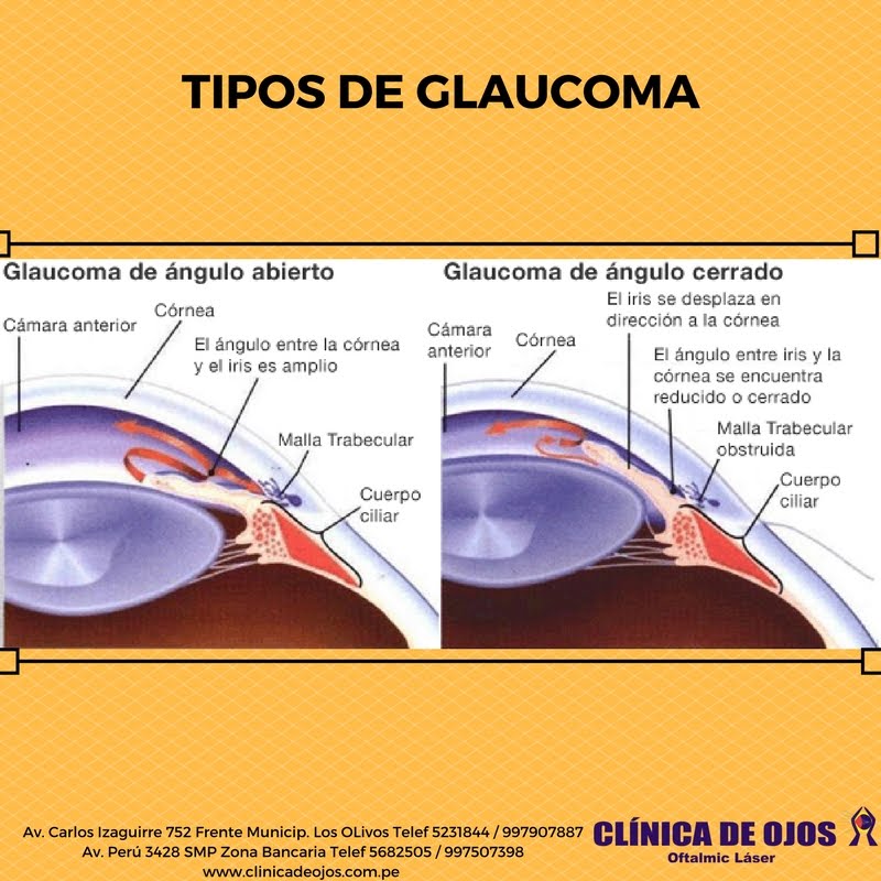 Clínica de Ojos Oftalmic Láser TIPOS DE