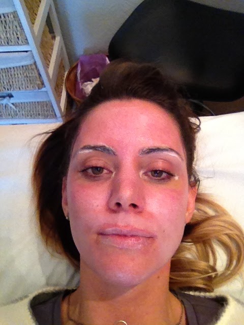 Tca Face Peel