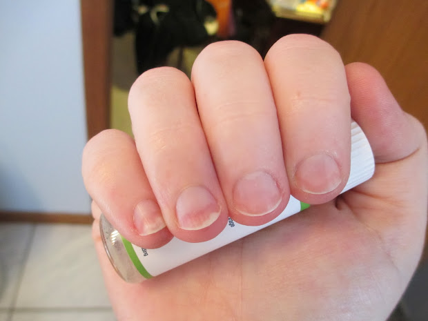 Anemia White Nails Vtwctr