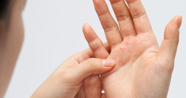 Psoriasi con forfora